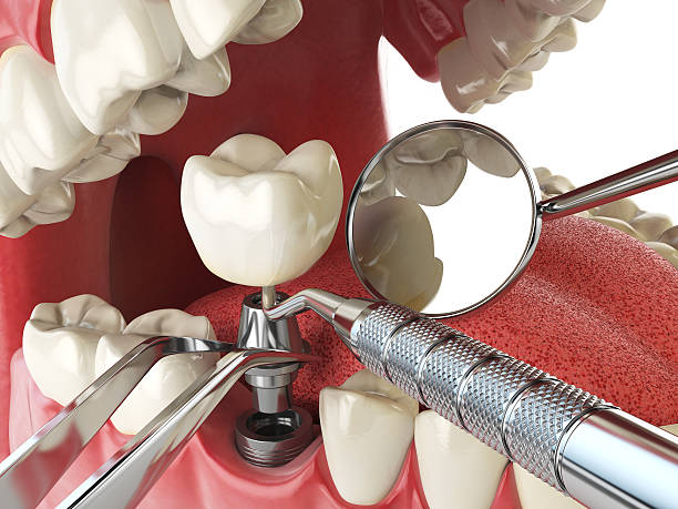Best Emergency Treatment for Dental Infections or Abscesses in Key Center, WA